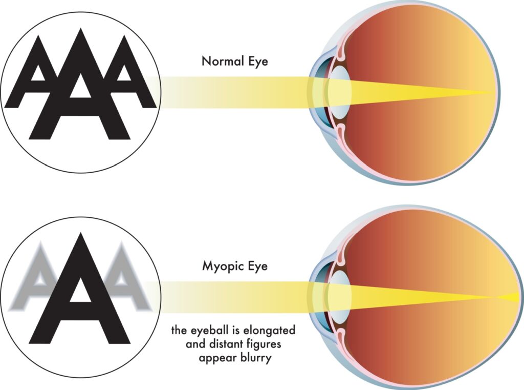 An image depicting the difference between a normal eye and an elongated myopic eye, showing how the light focuses in front of the retina.