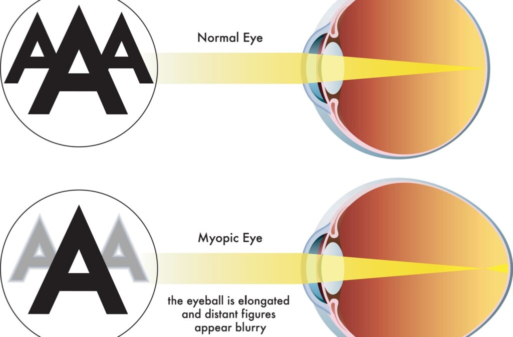 A infographic depicting the different in vision from a normal eye and a myopic eye.